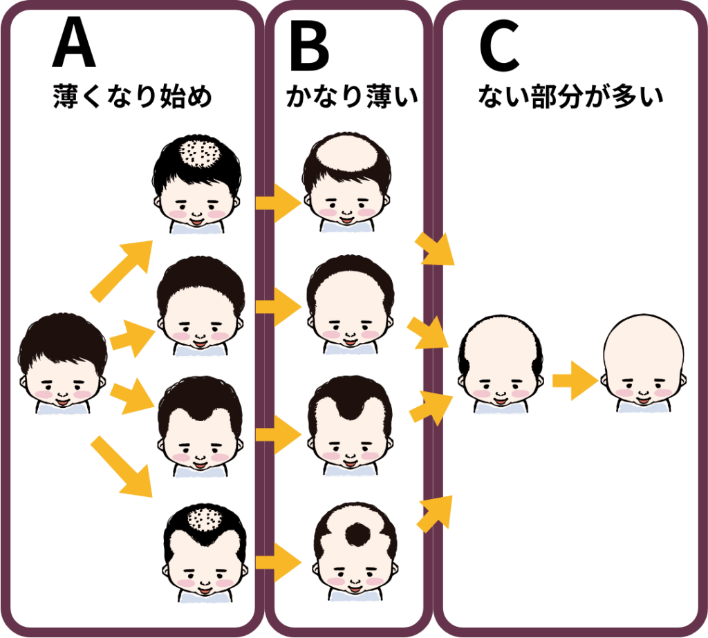 あなたの薄毛の進行状況はどれ？ A：薄くなり始め B：かなり薄い C：ない部分が多い